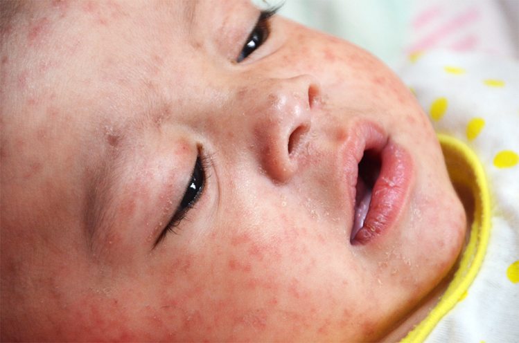 खसरा भारत में शिशु मृत्यु का सबसे बड़ा कारण है Measles is the leading reason for death in children